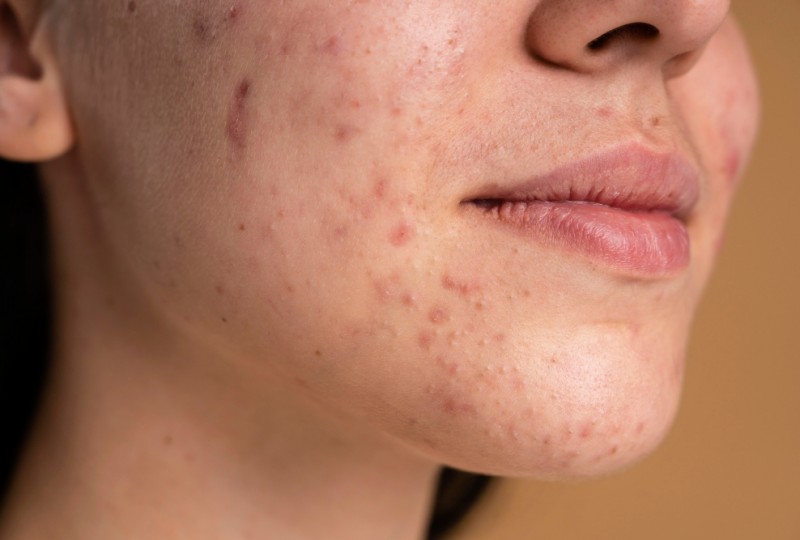 Những bước giúp da sạch mụn sau một thời gian ngắn